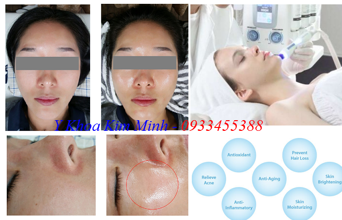 Cong dung cua may tre hoa da Han Quoc Aqua Sure H2 - Y khoa Kim Minh 0933455388