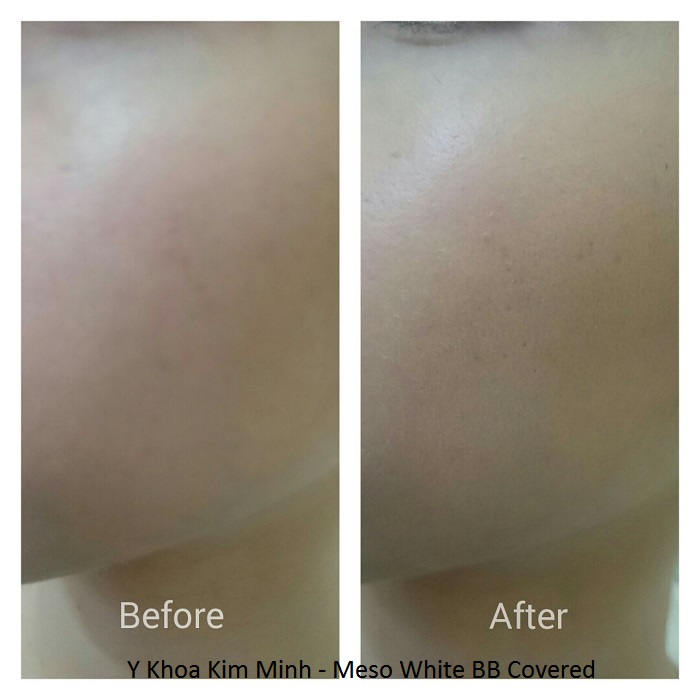 BB Cover Meso White cấy phấn nuôi da Y Khoa Kim Minh
