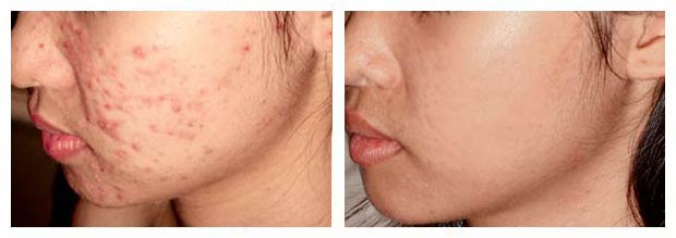 Cach dieu tri mun cam mun dau dien, mun cam hieu qua Pure Clear Y Khoa Kim Minh