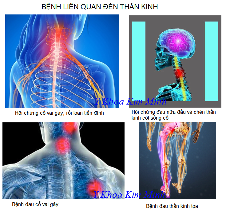 Dầu Quế Sơn giúp điều trị cột sống, dây thần kinh - Y Khoa Kim Minh Benh dau cot song, xuong khop, day than kinh | dau Que Son - Y Khoa Kim Minh 0933455388