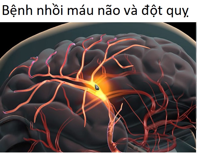 Bệnh nhồi máu não, bệnh đột quỵ - Y Khoa Kim Minh Bệnh nhồi máu não và bệnh đột quỵ có giống nhau không?