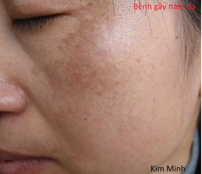 Nám da có phải do bệnh gan gây ra không, làm cách nào chữa bệnh nám da?