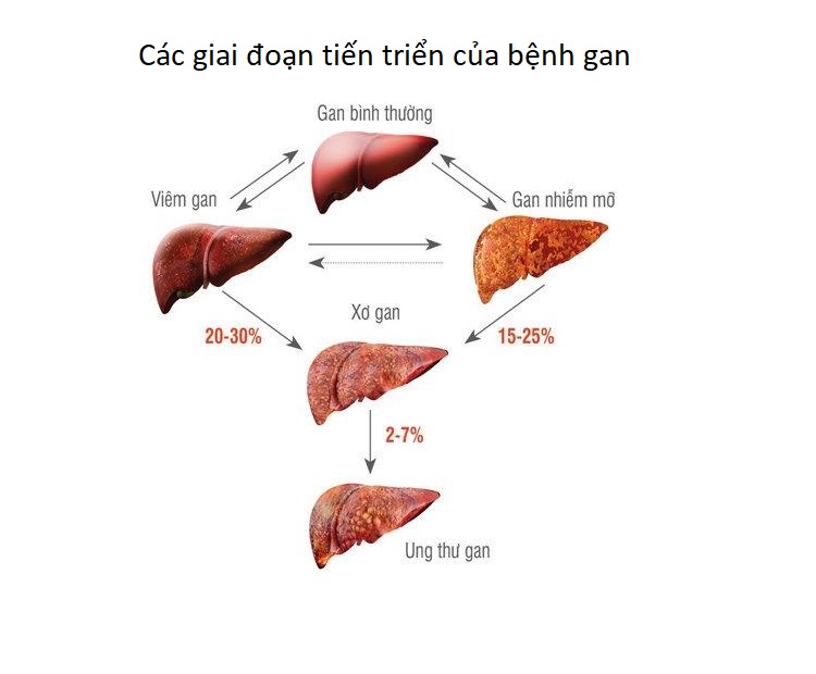 Bệnh gan nhiễm mỡ, bệnh xơ gan, u gan, ung thu gan la gi?