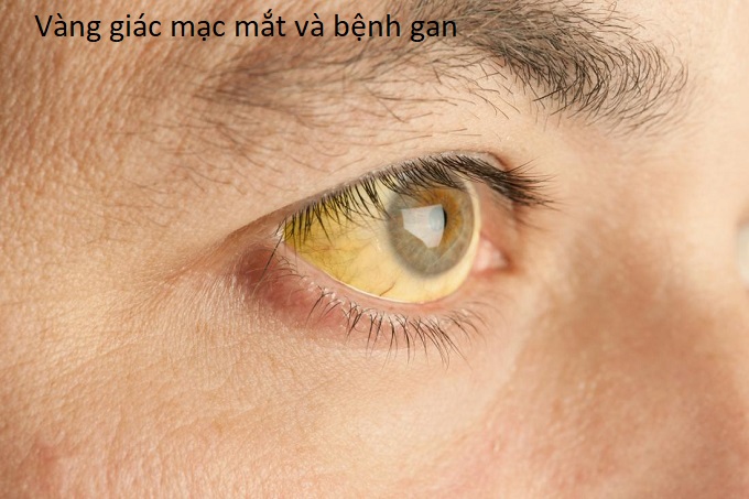 Vàng giác mạc mắt, vàng võng mạc có liên quan đến bệnh gan - Y khoa Kim Minh