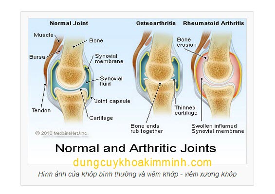 Bệnh viêm xương khớp