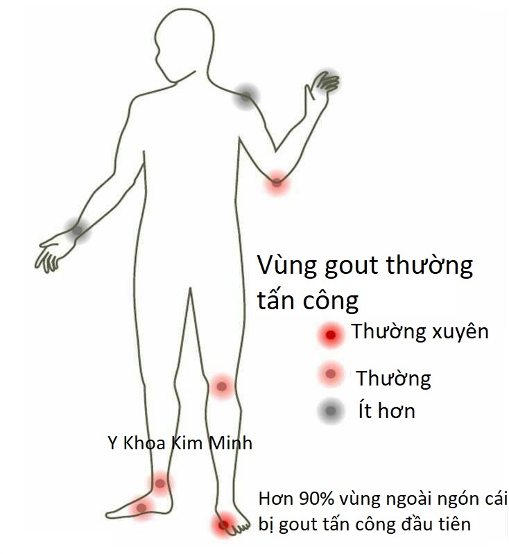 Nguyên nhân và biểu hiện bệnh gout như thế nào?