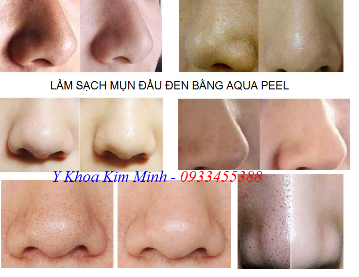 Hướng dẫn sử dụng điều trị mụn đầu đen bằng Aqua Peel - Y khoa Kim Minh 0933455388