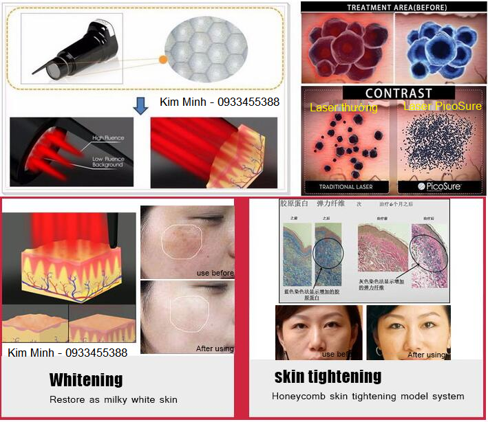 But ban laser xao xam tri nam tre hoa da NeatCell mini Y Khoa Kim Minh phan phoi ban tai tp hochiminh