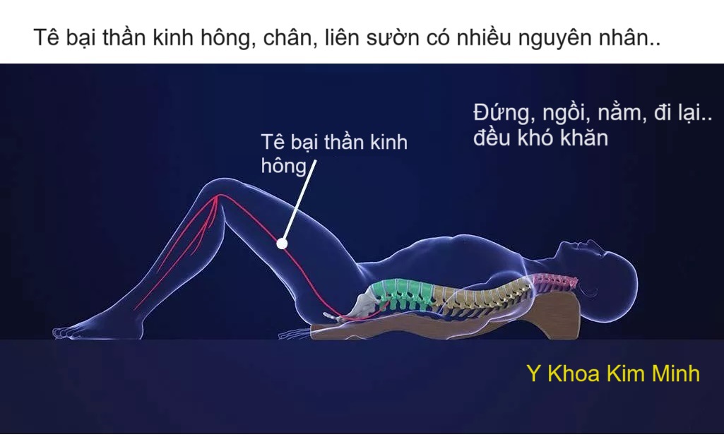 Nguyên nhân gây bệnh thần kinh tọa, tê bại thần kinh