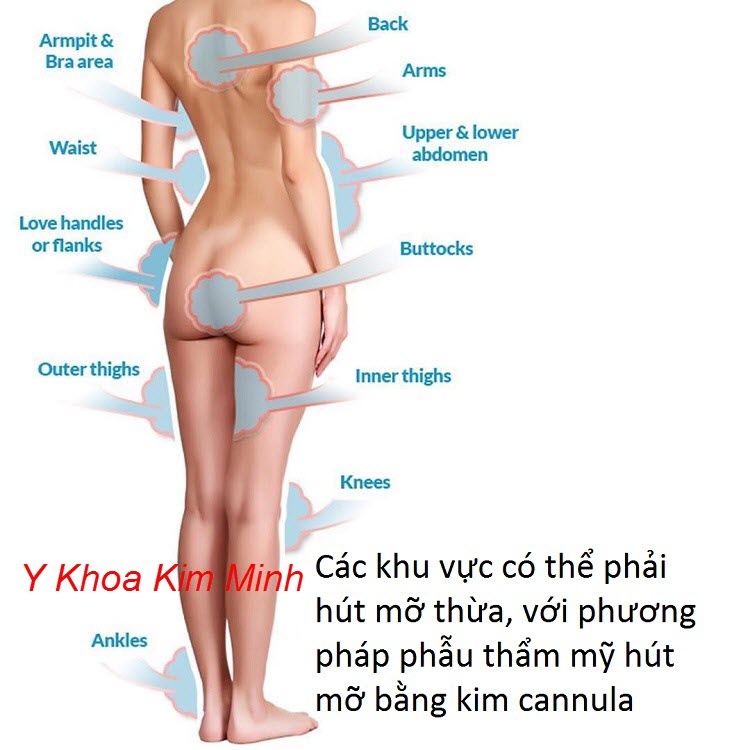 Các vùng trên cơ thể bị mỡ thừa nhiều có thể dùng kim cannula hút mỡ