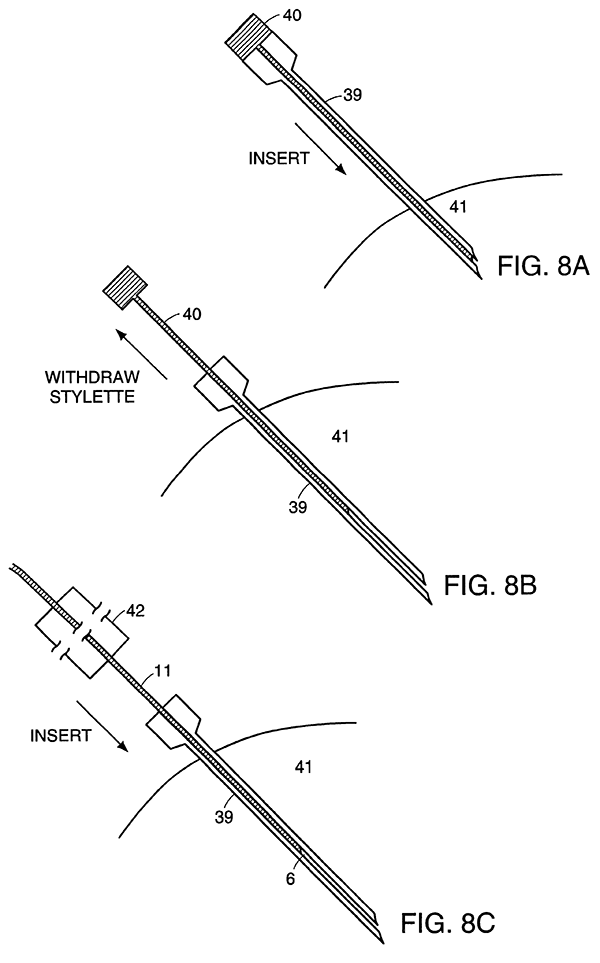 Kim quang dẫn laser nội mạch Y Khoa Kim Minh