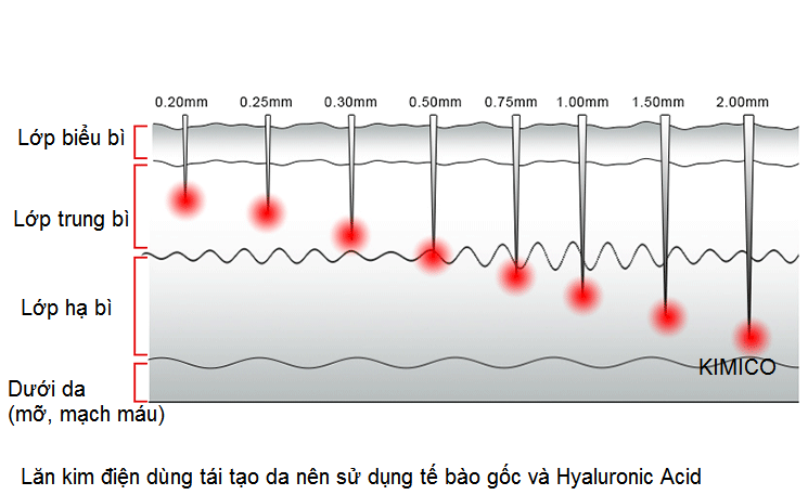Cach chinh dau kim lan dien Y Khoa Kim Minh