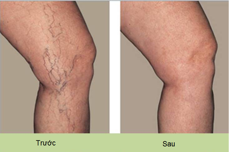 Noi chua benh gian tinh mach chan | treatment vein in Viet Nam - Y khoa Kim Minh 0933455388