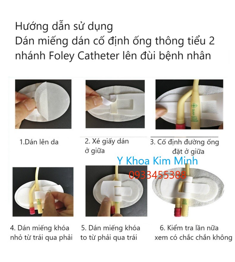 Hướng dẫn cách sử dụng đặt miếng dán cố định ống thông tiểu foley 2 nhánh lên đùi bệnh nhân