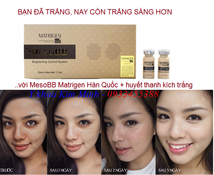 Cách dưỡng kích trắng  da tức thì bằng huyết thanh MesoBB Matrigen Hàn Quốc - Y khoa Kim Minh