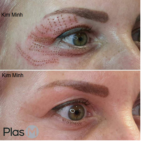 Hoc cach nhan mi o dau bang may dot dien plasma pen mini Y Khoa Minh