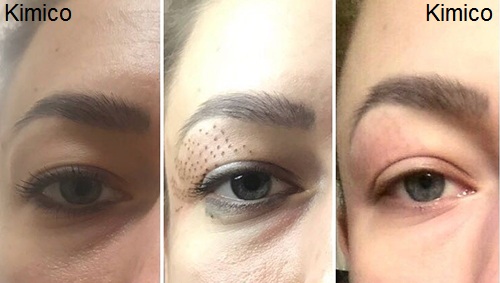 But dot dien plasma, may nhan mini, may xoa not roi tan nhang, may dot mun thit Kim Minh