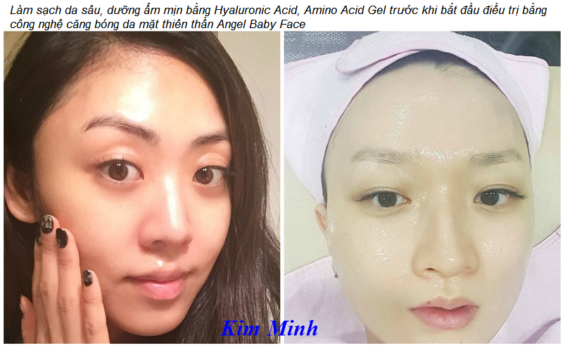 Cac buoc tao lan da cang bong thien than bang cong nghe Glass Skin - Y Khoa Kim Minh