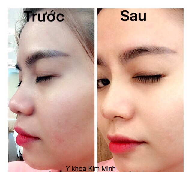 Cang chi vang 4D, chi xoan 4D Ultra V lift Korea 30mm, 50mm, 80mm Y Khoa Kim Minh