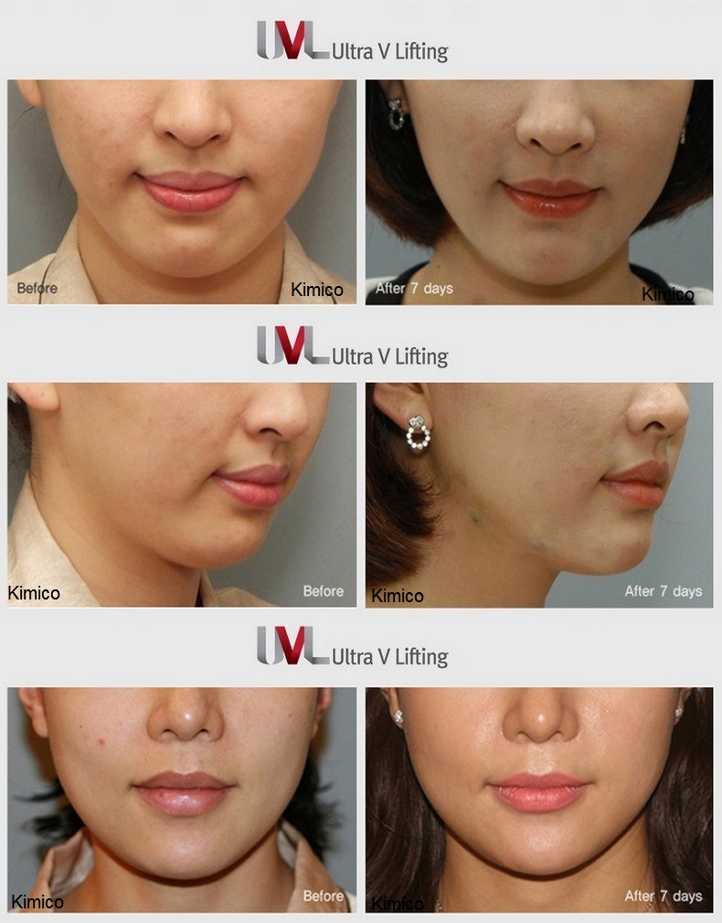 Dia chi ban chi cang da mat 4D Ultra V Lift Han quoc Y Khoa Kim Minh