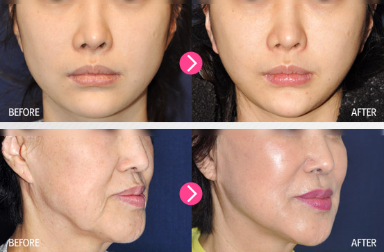 Cang da mat, tai tao da bang cong nghe chi vang 4D Ultra V lift Han quoc Y Khoa Kim Minh