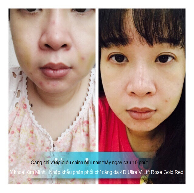 Cong ty ban chi cang da 4D Ultra V-Lift Gold Rose Red Han quoc Y Khoa Kim Minh