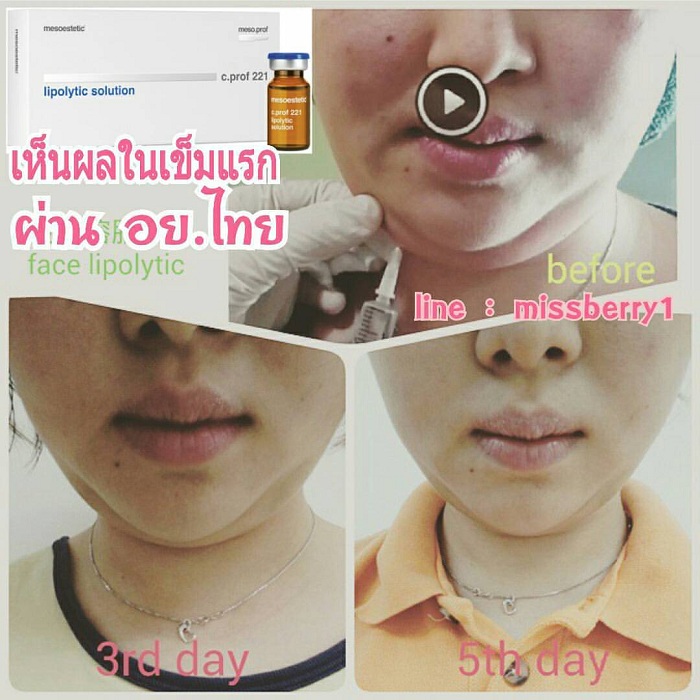 Chat chich thu gon khuon mat Lipolytic solution mesoestetic c prof 221 Y khoa Kim Minh