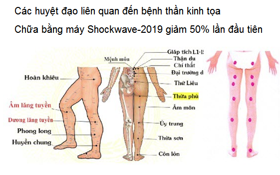 Chữa bệnh thần kinh tọa bằng máy xung kích shockwave-2019 - Y Khoa Kim Minh 0933455388