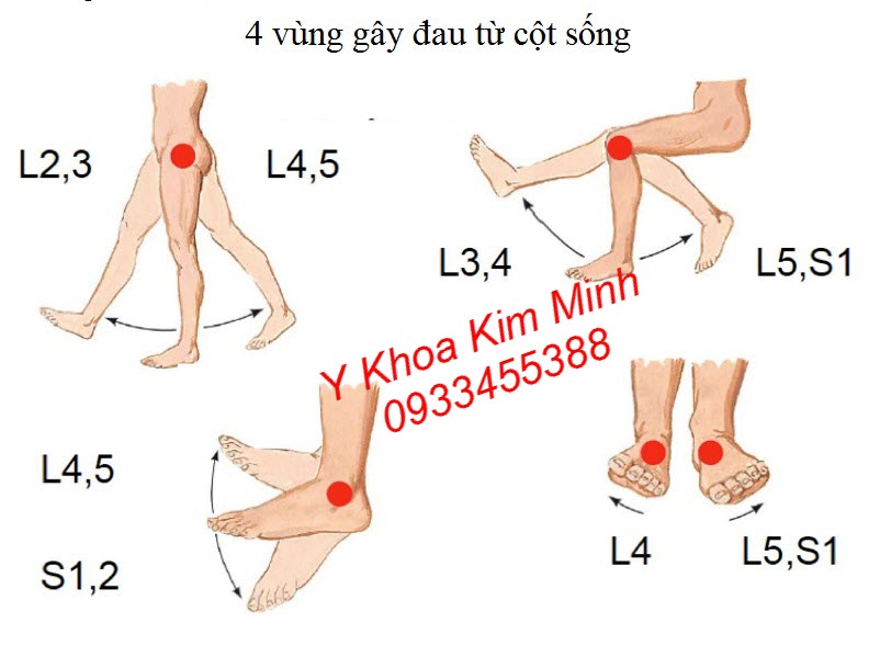 Dùng tinh dầu quết sơn làm lưu thông máu các vùng huyệt đạo L3, L4, L5, S1-->S5 - Y khoa Kim Minh Kiểm tra vùng đau cột sống L3, L4, L5 trước khi dùng tinh dầu quế sơn điều trị tê bại - Y khoa Kim Minh