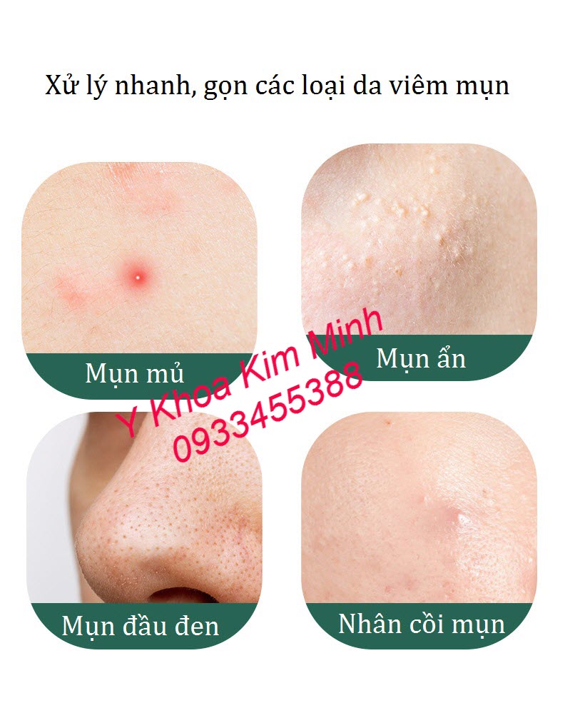 Công dụng và sự an toàn khi dùng cây nặn mụn 2 trong 1 Nhật Bản