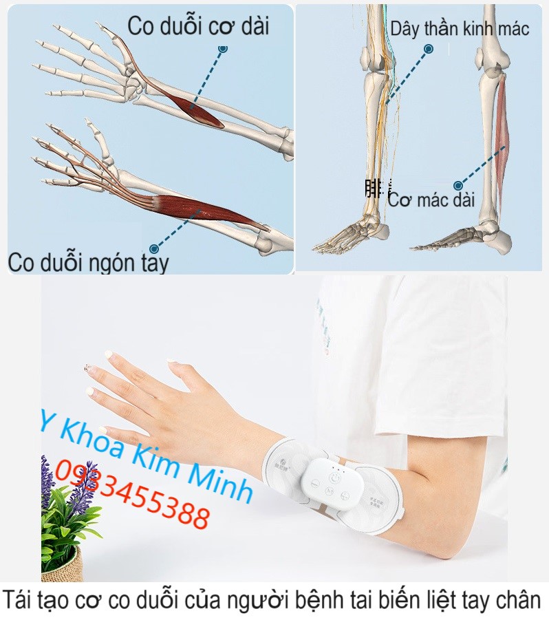 Công dụng của máy tập phục hồi người bệnh liệt sau tai biến EMS