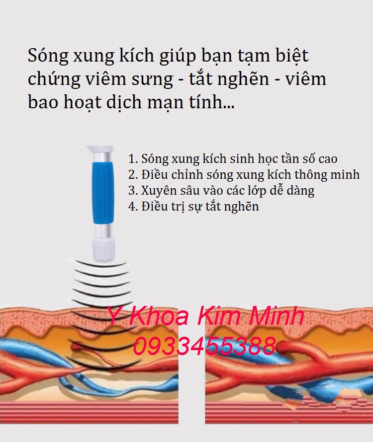 Công dụng của sóng xung kích shockwave điều trị cơ xuong khớp