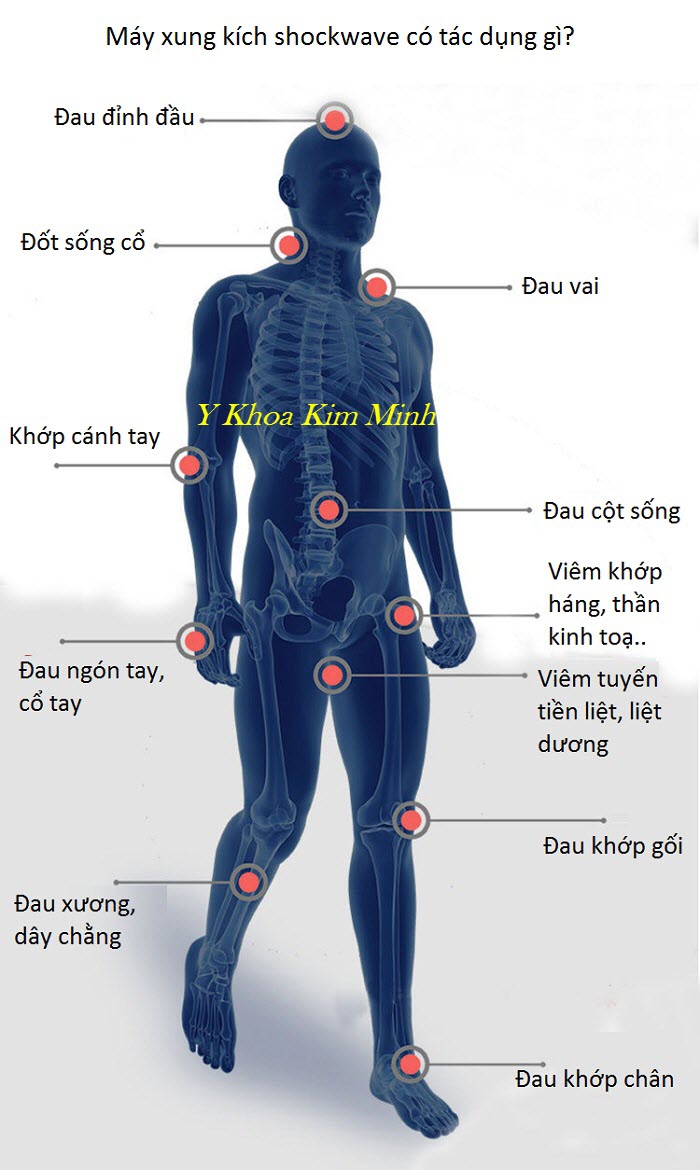 Công dụng điều trị của máy xung kích shockwave dùng cho ngành vật lý trị liệu - Y khoa Kim Minh