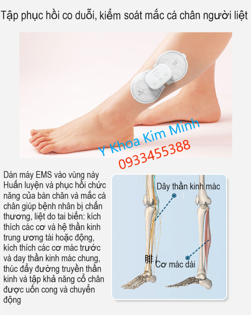 Máy dán EMS điều trị liệt chân do bệnh tai biến