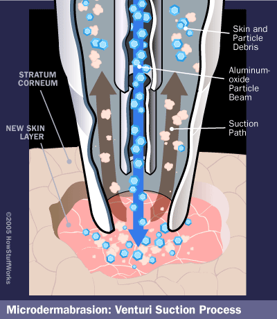 M&aacute;y c&agrave; da trẻ h&oacute;a tế b&agrave;o c&ocirc;ng nghệ Hydro Microdermabrasion
