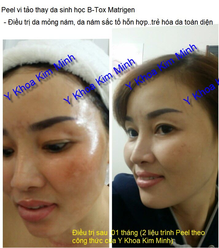 Cach thuc peel thay da sinh hoc han quoc B-Tox Peel Matrigen Y Khoa Kim Minh