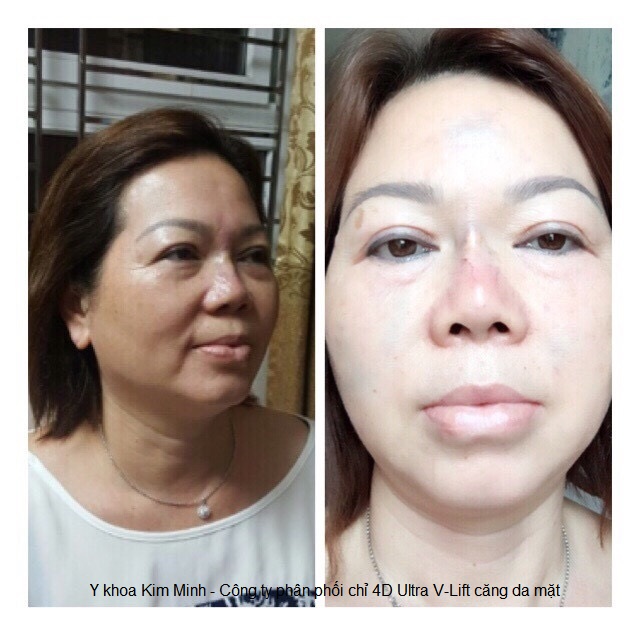Căng chỉ v&agrave;ng 4D Ultra V-lift H&agrave;n quốc kh&ocirc;ng cần phẫu thuật Y Khoa Kim Minh