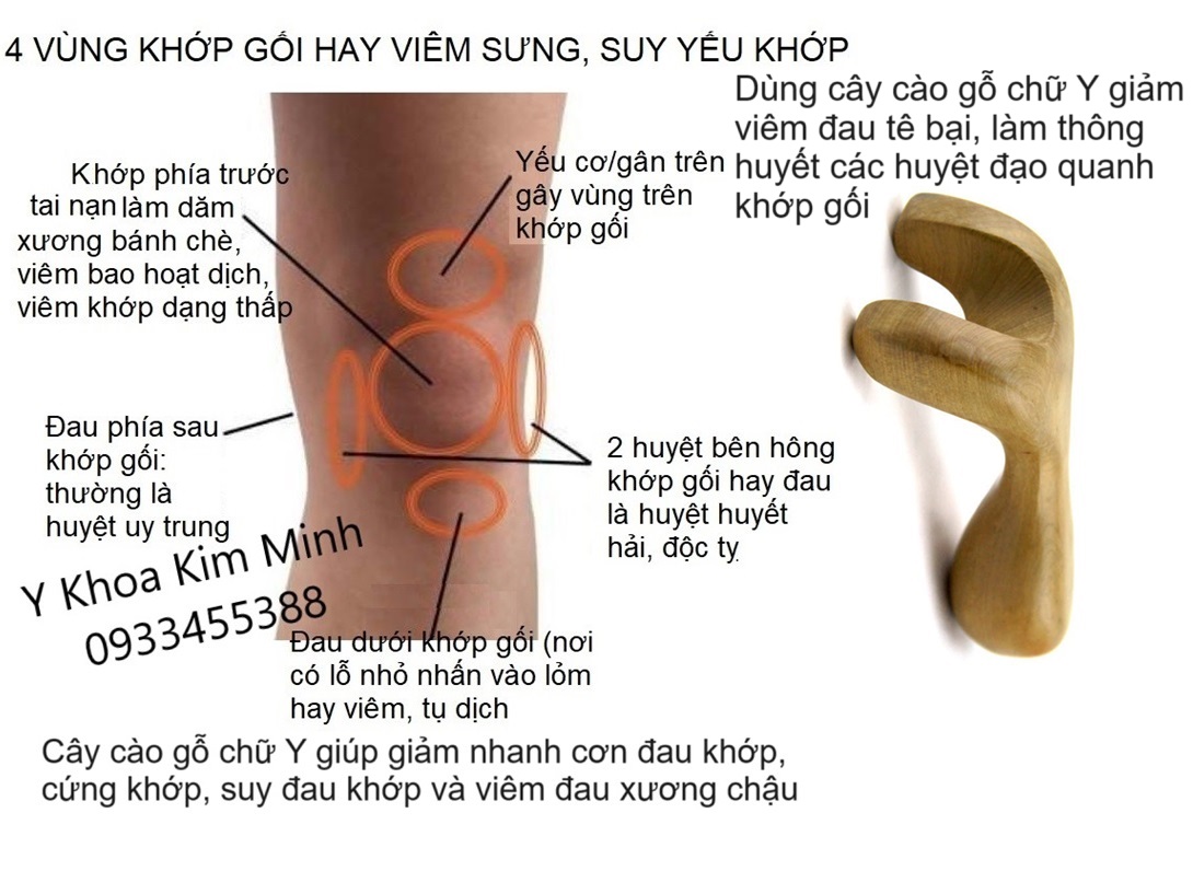 Cào gỗ chữ Y chữa đau khớp gối rất hay