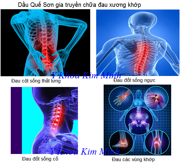 Dầu Quế Sơn gia truyền 30ml - Y Khoa Kim Minh Dầu Quế Sơn gia truyền chữa viêm xương khớp bán tại Tp Hồ Chí Minh - Y Khoa Kim Minh 0933455388