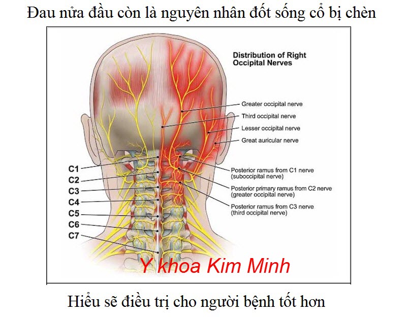 Dùng tinh dầu quế sơn trị đua nửa đầu rất hiệu quả - Y khoa Kim Minh Trị đau đầu, đau nữa đầu bằng tinh dầu quế sơn massage day ấn huyệt đạo C1-C7 - Y khoa Kim Minh