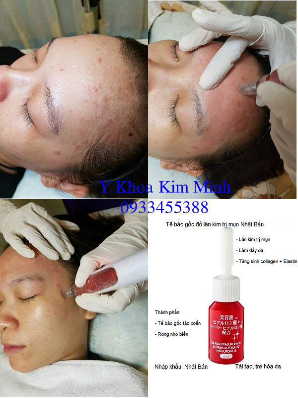 Te bao goc do lan kim tri mun nhap khau Nhat Ban Y Khoa Kim Minh ban tai 95 Thanh Thai