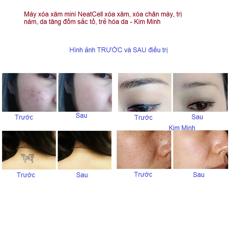 Dieu tri cham soc da truoc va sau khi su dung may laser neatcell mini Y Khoa Kim Minh