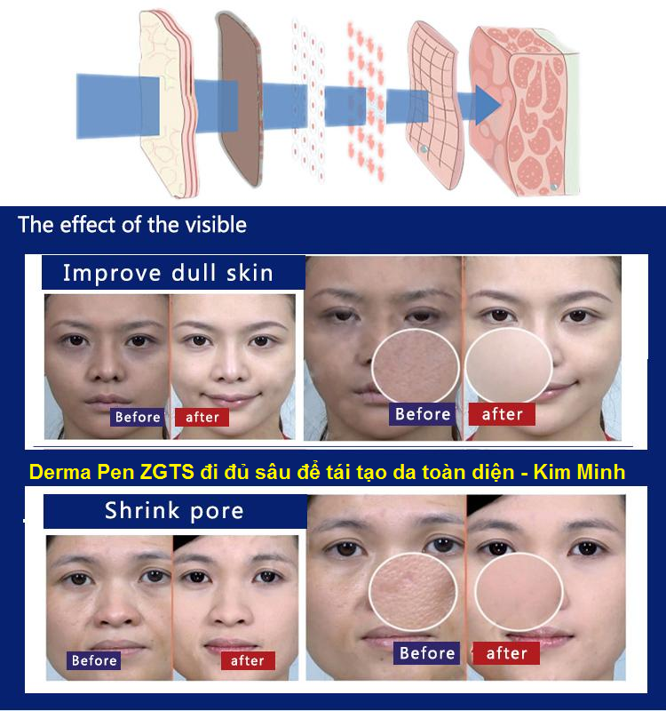 Derma Pen nhanh chóng tái tạo làn da mới Cham soc dieu tri da bang may lan kim dien ZGTS Derma Pen Y khoa Kim Minh