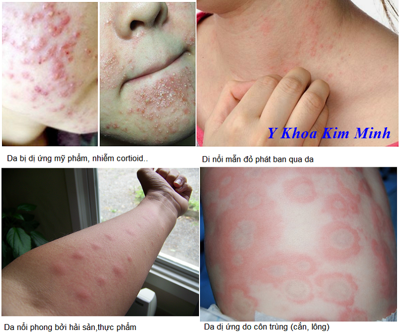 Nếu da bạn bị dị ứng mỹ phẩm, hải sải, thực phẩm chức năng, thuốc, làm cách nào giải độc cơ địa nhanh? Điều trị da dị ứng hải sản, dị ứng mỹ phẩm, thuốc, thực phẩm bằng viên thuốc thảo dược Đông Y Việt Nam - Y khoa Kim Minh