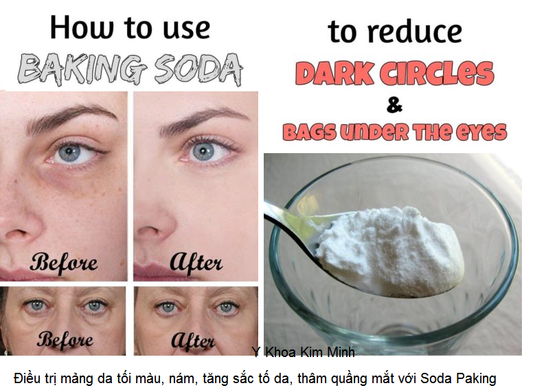 Dieu tri da toi mau, tang mang sac to, tri tham nang va thang quang mat bang soda paking kim minh