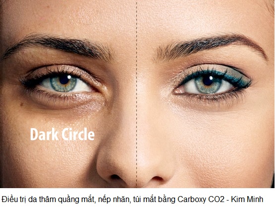Dieu tri da quang tham mat, nep nhan mat, bong mat bang phuong phap Carboxy CO2 Y Khoa Kim Minh 0933455388