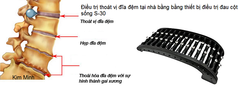 Dieu tri dau cot song, thoat vi dia dem bang thiet bi S-30 - Y khoa Kim Minh