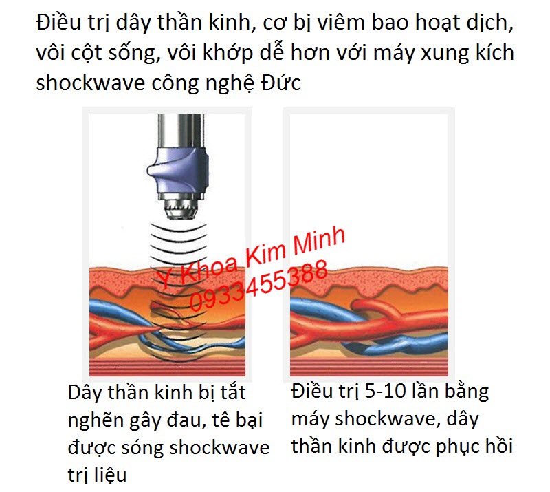 Sóng xung kích shockwave là gì? Nó có tốt cho sức khoẻ con người hay không?