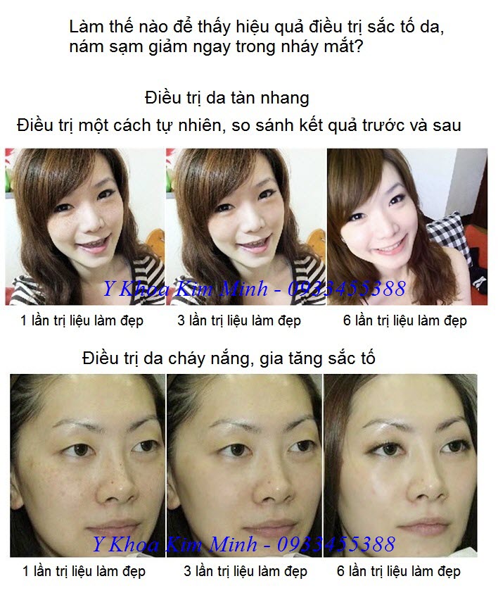 Điều trị tàn nhang, da tăng sắc tố bằng máy laser picosecond 755nm - Y Khoa Kim Minh