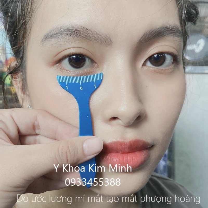 Thước đo ước lượng mí mát phẫu thuật thẩm mỹ tạo mắt phượng hoàng